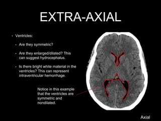 EXTRA-AXIAL
Notice in this example
that the ventricles are
symmetric and
nondilated.
Axial
• Ventricles:
• Are they symmetric?
• Are they enlarged/dilated? This
can suggest hydrocephalus.
• Is there bright white material in the
ventricles? This can represent
intraventricular hemorrhage.
 