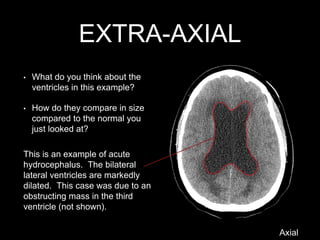 EXTRA-AXIAL
This is an example of acute
hydrocephalus. The bilateral
lateral ventricles are markedly
dilated. This case was due to an
obstructing mass in the third
ventricle (not shown).
• What do you think about the
ventricles in this example?
• How do they compare in size
compared to the normal you
just looked at?
Axial
 