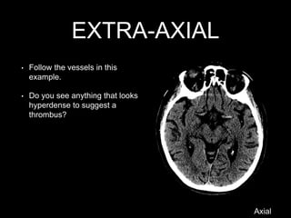 EXTRA-AXIAL
• Follow the vessels in this
example.
• Do you see anything that looks
hyperdense to suggest a
thrombus?
Axial
 