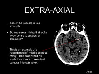 EXTRA-AXIAL
• Follow the vessels in this
example.
• Do you see anything that looks
hyperdense to suggest a
thrombus?
This is an example of a
hyperdense left middle cerebral
artery. This patient had an
acute thrombus and resultant
cerebral infarct (stroke).
Axial
 