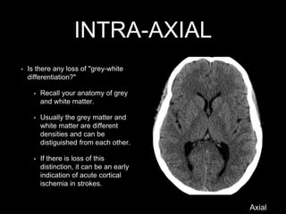 INTRA-AXIAL
• Is there any loss of "grey-white
differentiation?"
• Recall your anatomy of grey
and white matter.
• Usually the grey matter and
white matter are different
densities and can be
distiguished from each other.
• If there is loss of this
distinction, it can be an early
indication of acute cortical
ischemia in strokes.
Axial
 