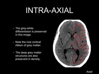 INTRA-AXIAL
• The grey-white
differentiaion is preserved
in this image.
• Note the nice cortical
ribbon of grey matter.
• The deep grey matter
structures are also
preseverd in density.
Axial
 