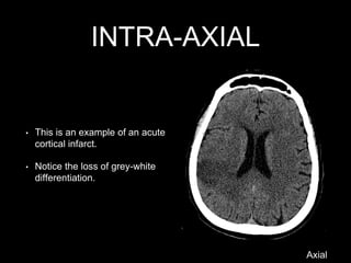 INTRA-AXIAL
• This is an example of an acute
cortical infarct.
• Notice the loss of grey-white
differentiation.
Axial
 
