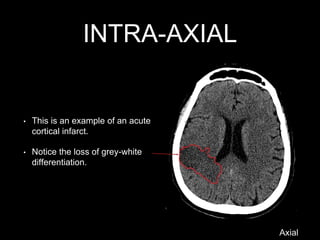 INTRA-AXIAL
• This is an example of an acute
cortical infarct.
• Notice the loss of grey-white
differentiation.
Axial
 