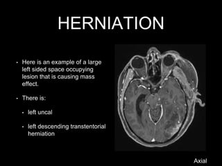 HERNIATION
Axial
• Here is an example of a large
left sided space occupying
lesion that is causing mass
effect.
• There is:
• left uncal
• left descending transtentorial
herniation
 