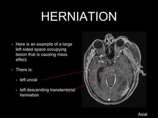 HERNIATION
• Here is an example of a large
left sided space occupying
lesion that is causing mass
effect.
• There is:
• left uncal
• left descending transtentorial
herniation
Axial
 