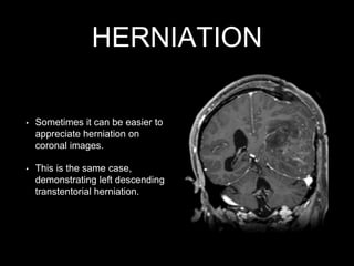 HERNIATION
• Sometimes it can be easier to
appreciate herniation on
coronal images.
• This is the same case,
demonstrating left descending
transtentorial herniation.
 
