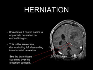 HERNIATION
• Sometimes it can be easier to
appreciate herniation on
coronal images.
• This is the same case,
demonstrating left descending
transtentorial herniation.
See the brain tissue
squishing over the
tentorium cerebelli.
 