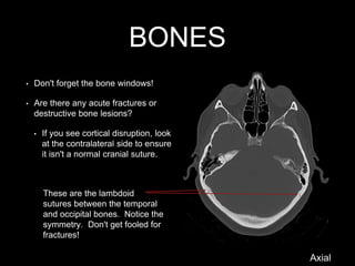BONES
• Don't forget the bone windows!
• Are there any acute fractures or
destructive bone lesions?
• If you see cortical disruption, look
at the contralateral side to ensure
it isn't a normal cranial suture.
These are the lambdoid
sutures between the temporal
and occipital bones. Notice the
symmetry. Don't get fooled for
fractures!
Axial
 