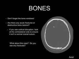 BONES
• Don't forget the bone windows!
• Are there any acute fractures or
destructive bone lesions?
• If you see cortical disruption, look
at the contralateral side to ensure
it isn't a normal cranial suture.
What about this case? Do you
see any fractures?
Axial
 