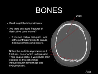 BONES
• Don't forget the bone windows!
• Are there any acute fractures or
destructive bone lesions?
• If you see cortical disruption, look
at the contralateral side to ensure
it isn't a normal cranial suture.
Notice the multiple asymmetric skull
fractures, one of which is depressed.
There is also part of a ventricular drain
depicted as this patient had
intraventricular hemorrhage and
hydrocephalus.
Drain
Axial
 