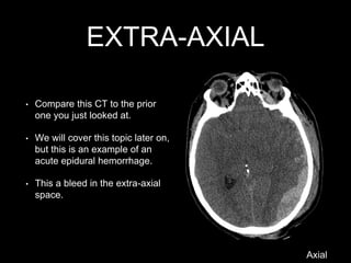 EXTRA-AXIAL
• Compare this CT to the prior
one you just looked at.
• We will cover this topic later on,
but this is an example of an
acute epidural hemorrhage.
• This a bleed in the extra-axial
space.
Axial
 