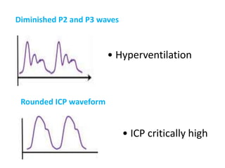 Diminished P2 and P3 waves
• Hyperventilation
Rounded ICP waveform
• ICP critically high
 