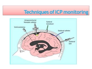 Techniques of ICP monitoring
 