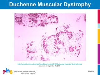 Duchenne Muscular Dystrophy




  http://upload.wikimedia.org/wikipedia/commons/4/49/Duchenne-muscular-dystrophy.jpg
                             Accessed on September 20, 2010



                                                                                       11 of 56
 