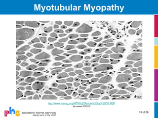 Myotubular Myopathy




  http://www.mtmrg.org/MTM%20Article%20by%20CR.PDF
                   Accessed 9/20/10

                                                     18 of 56
 