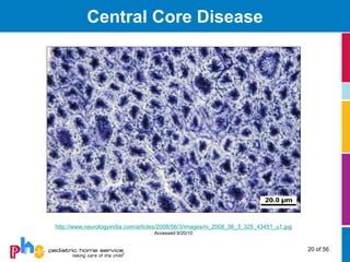 Central Core Disease




http://www.neurologyindia.com/articles/2008/56/3/images/ni_2008_56_3_325_43451_u1.jpg
                                   Accessed 9/20/10


                                                                                        20 of 56
 
