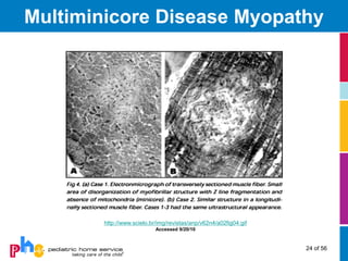 Multiminicore Disease Myopathy




        http://www.scielo.br/img/revistas/anp/v62n4/a02fig04.gif
                            Accessed 9/20/10



                                                                   24 of 56
 