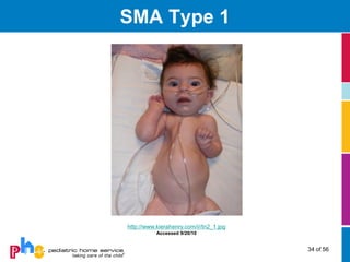 SMA Type 1




http://www.kierahenry.com/i//tn2_1.jpg
           Accessed 9/20/10


                                         34 of 56
 