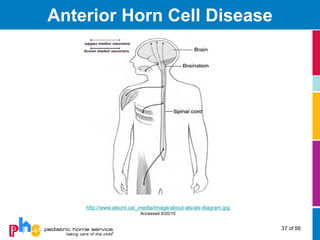 Anterior Horn Cell Disease




    http://www.alsont.ca/_media/Image/about-als/als-diagram.jpg
                          Accessed 9/20/10


                                                                  37 of 56
 