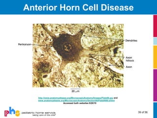Anterior Horn Cell Disease




   http://www.anatomyatlases.org/MicroscopicAnatomy/Images/Plate89.jpg and
   www.anatomyatlases.org/MicroscopicAnatomy/Section06/Plate0689.shtml
                         Accessed both websites 9/20/10



                                                                             39 of 56
 