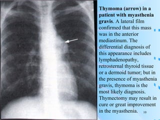 Thymoma (arrow) in a patient with myasthenia gravis . A lateral film confirmed that this mass was in the anterior mediastinum. The differential diagnosis of this appearance includes lymphadenopathy, retrosternal thyroid tissue or a dermoid tumor; but in the presence of myasthenia gravis, thymoma is the most likely diagnosis. Thymectomy may result in cure or great improvement in the myasthenia. 