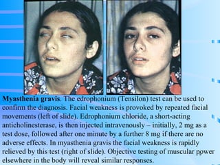 Myasthenia gravis . The edrophonium (Tensilon) test can be used to confirm the diagnosis. Facial weakness is provoked by repeated facial movements (left of slide). Edrophonium chloride, a short-acting anticholinesterase, is then injected intravenously – initially, 2 mg as a test dose, followed after one minute by a further 8 mg if there are no adverse effects. In myasthenia gravis the facial weakness is rapidly relieved by this test (right of slide). Objective testing of muscular power elsewhere in the body will reveal similar responses. 