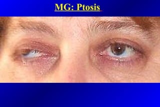 MG: Ptosis
 