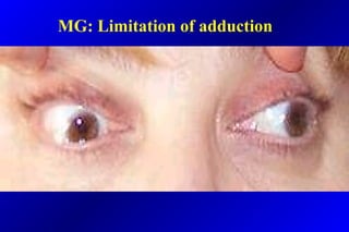 MG: Limitation of adduction
 