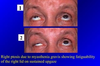 Right ptosis due to myasthenia gravis showing fatiguability
of the right lid on sustained upgaze
1
2
 
