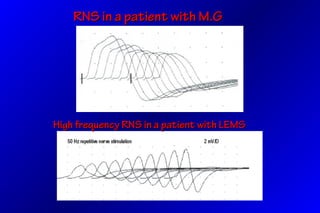 RNS in a patient with M.GRNS in a patient with M.G
High frequency RNS in a patient with LEMSHigh frequency RNS in a patient with LEMS
 