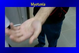 Myotonia
 