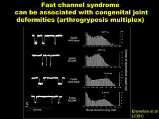 Fast channel syndrome
can be associated with congenital joint
deformities (arthrogryposis multiplex)

Brownlow et al
(2001)

 