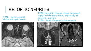 MRI:OPTIC NEURITIS
T1WI+: enhancement
of the left optic nerve.
T2WI:coronal (J) planes shows increased
signal in left optic nerve, especially its
posterior portion
T1WI+: Optic chiasma enhancement
 