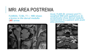 MRI: AREA POSTREMA
FLAIR(A), T2(B), T1+: MRI shows
a lesion in the dorsal medulla
(AP) arrow
Axial, FLAIR (D; arrows) and T1-
weighted MRI with gadolinium (E;
arrowheads) show dorsal medulla
involvement in a patient with acute
area postrema
 