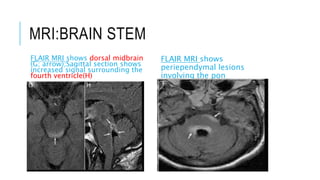 MRI:BRAIN STEM
FLAIR MRI shows dorsal midbrain
(G; arrow);Sagittal section shows
increased signal surrounding the
fourth ventricle(H)
FLAIR MRI shows
periependymal lesions
involving the pon
 