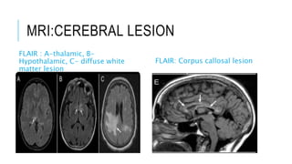 MRI:CEREBRAL LESION
FLAIR : A-thalamic, B-
Hypothalamic, C- diffuse white
matter lesion
FLAIR: Corpus callosal lesion
 