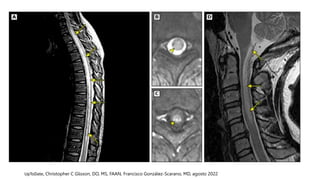 Neuromyelitis optica spectrum disorder (NMOSD).pptx
