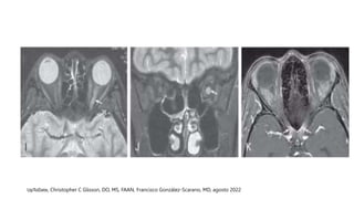 Neuromyelitis optica spectrum disorder (NMOSD).pptx