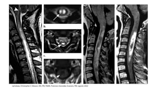 Neuromyelitis optica spectrum disorder (NMOSD).pptx