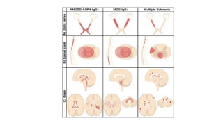 Neuromyelitis optica spectrum disorder (NMOSD).pptx