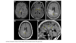 Neuromyelitis optica spectrum disorder (NMOSD).pptx