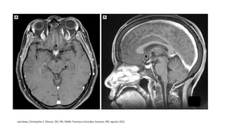 Neuromyelitis optica spectrum disorder (NMOSD).pptx