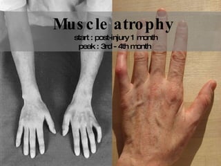 Muscle atrophy start : post-injury 1 month peak : 3rd - 4th month  