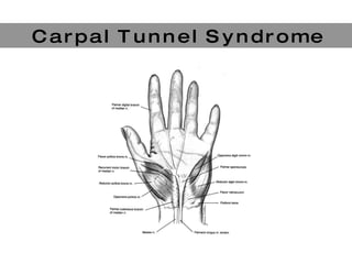 C a r p a l  T u n n e l  S y n d r o m e 
