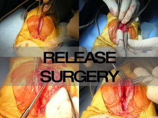 RELEASE SURGERY 