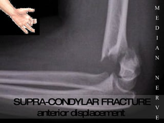 SUPRA-CONDYLAR FRACTURE anterior displacement   M E D I A N N E R V E 
