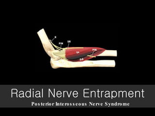Radial Nerve  Entrapment Posterior Interosseous Nerve Syndrome   