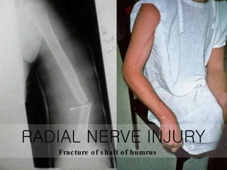 RADIAL NERVE INJURY Fracture of shaft of humrus  
