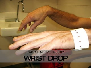 RADIAL NERVE INJURY WRIST DROP 